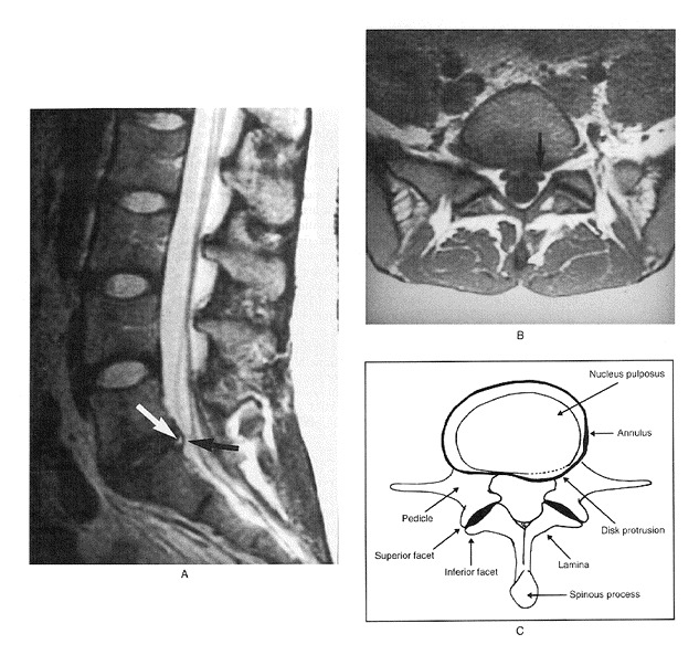 The MRI of a woman who has a disk protrusion but no back pain.