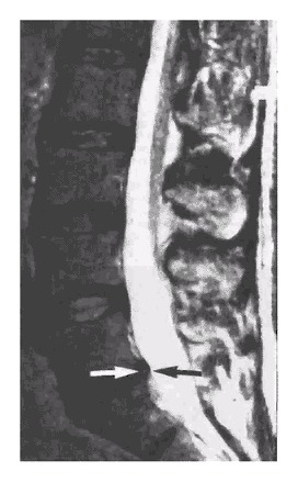 An MRI of a woman who has a disk bulge but no back pain.
